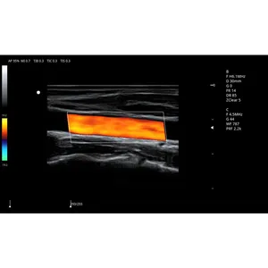 Color Doppler Ultrasound System